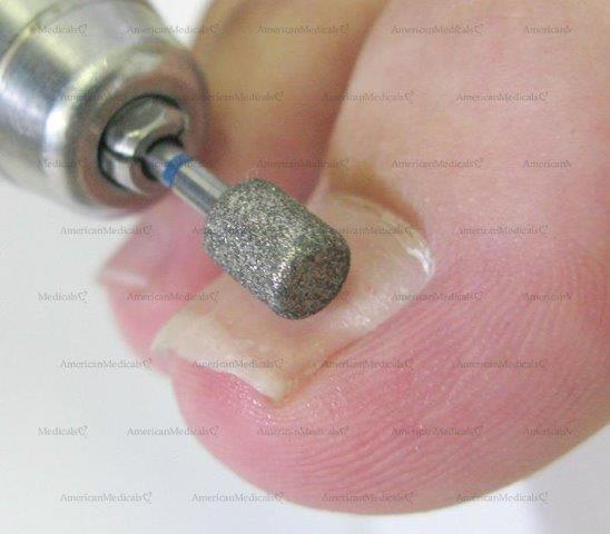 safe-toe® round-edge grinder podiatry bur from american medicals