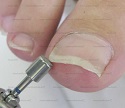 safe-toe® top grinder podiatry bur from american medicals