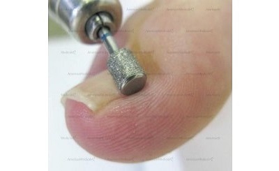 safe-toe side grinder podiatry bur